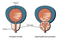 schéma hypertrophie bénigne de la prostate