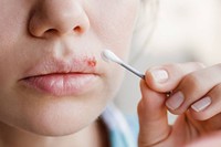 herpes-labial-danger
