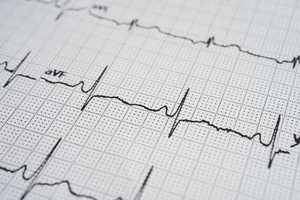 Arythmie cardiaque : symptômes, causes et traitements
