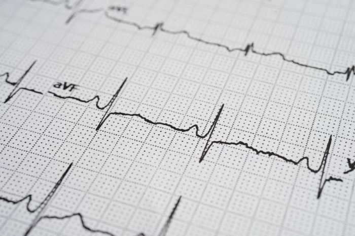 Arythmie cardiaque : symptômes, causes et traitements