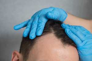 Greffe de cheveux : méthode, convalescence et avis