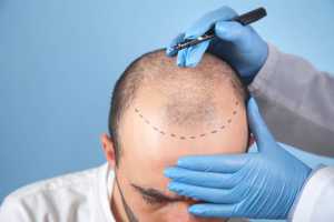 Implantation cheveux : méthodes et différences entre hommes et femmes