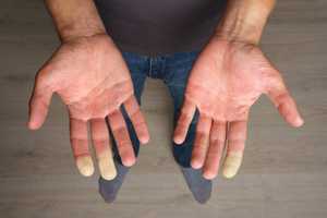 Maladie de Raynaud : traitements et solutions naturelles