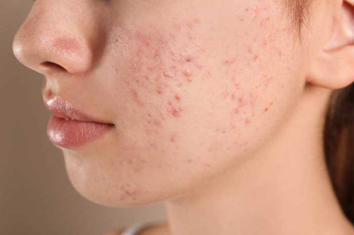 Acné hormonale : symptômes et traitements