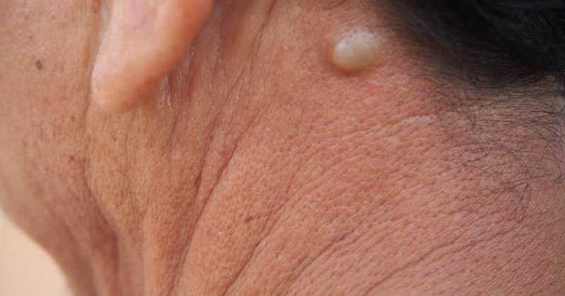 Kayste Kyste sébacé : causes et traitements | Charles.co