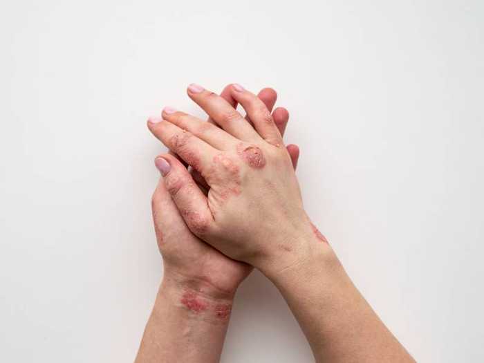 Psoriasis traitement : naturel, efficace et sans ordonnance ...