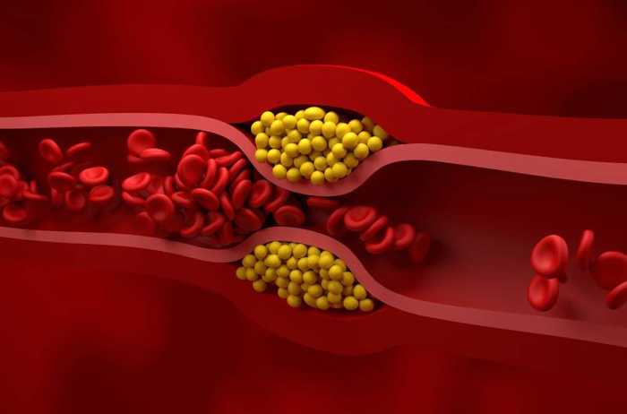 Médicament cholestérol : sans statine, dangereux et le meilleur