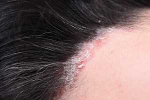 Psoriasis cheveux : traitement, cuir chevelu et perte de cheveux