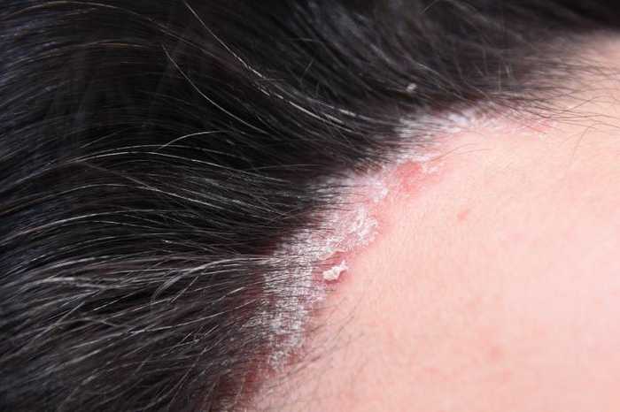 Psoriasis cheveux : traitement, cuir chevelu et perte de cheveux