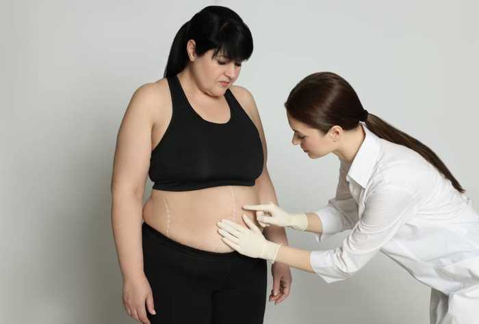 Opération de l’estomac pour maigrir : sleeve, bypass et avis