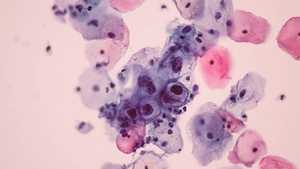 Papillomavirus : symptômes, causes, traitements