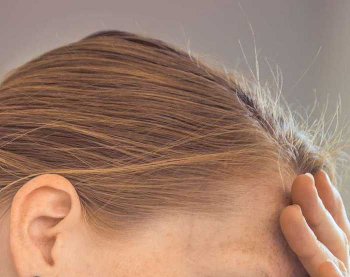 Perte de cheveux au devant du crâne de la femme : que faire ?