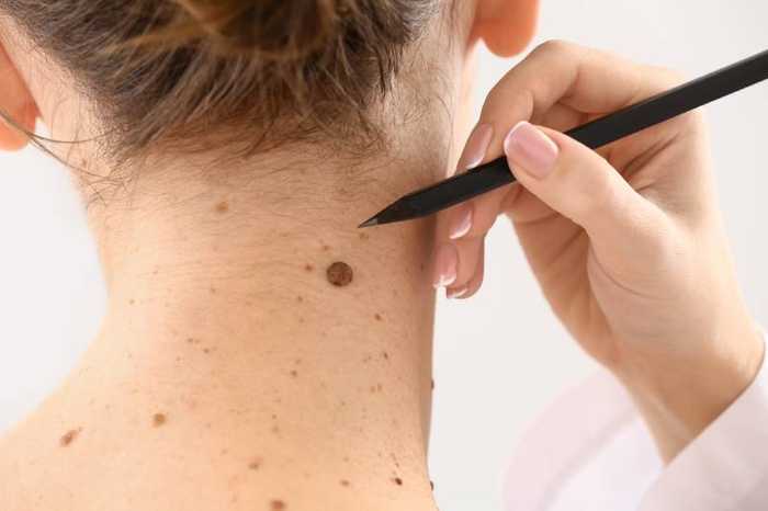 Grains de beauté : comment savoir s’ils sont dangereux ?