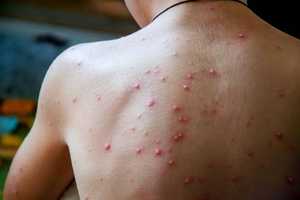 Bouton varicelle : causes, évolution, traitements et prévention