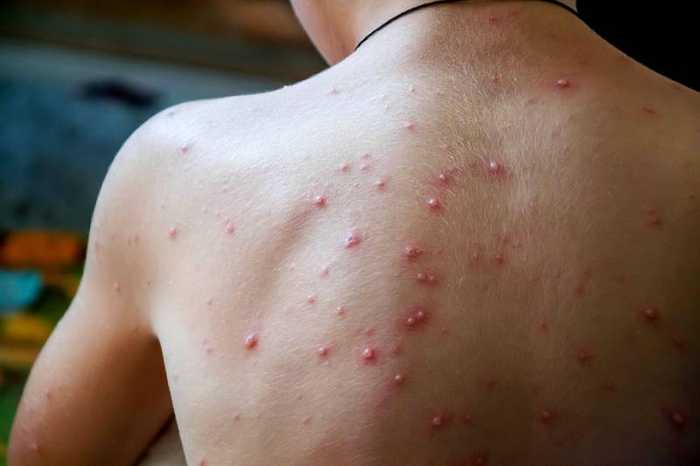Bouton varicelle : causes, évolution, traitements et prévention