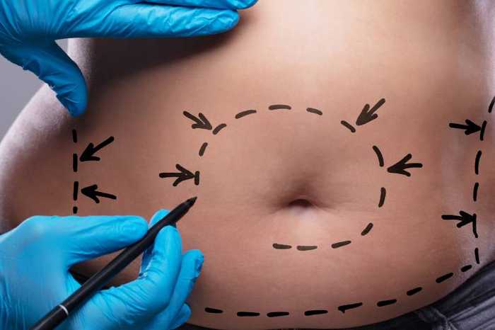 Liposuccion ventre : quel est le prix de cette chirurgie ?